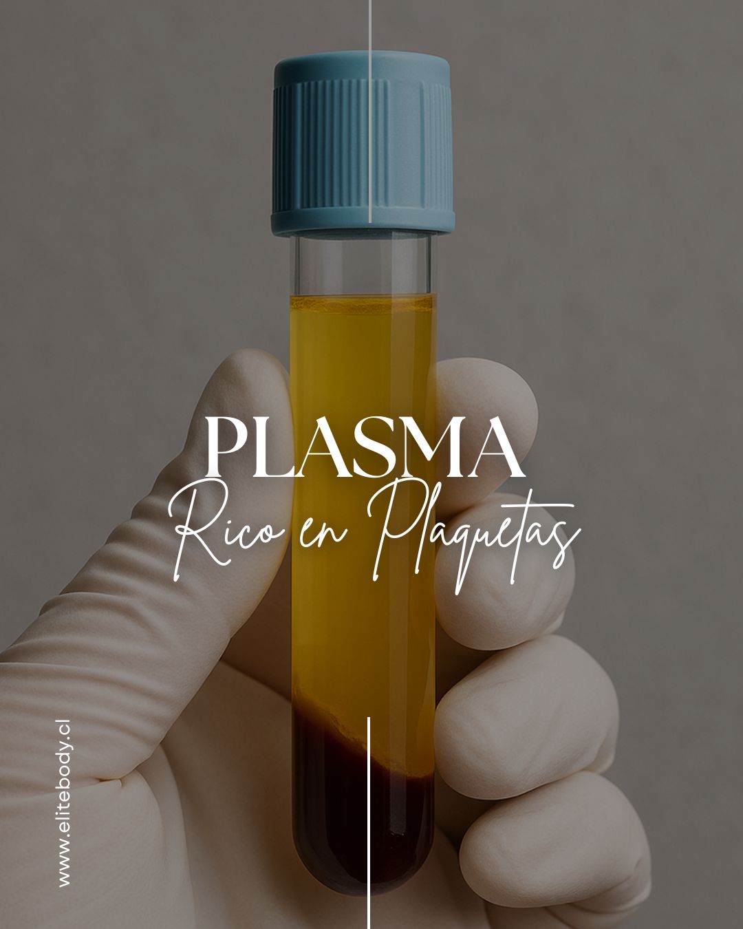PLASMA RICO EN PLAQUETAS (PRP)