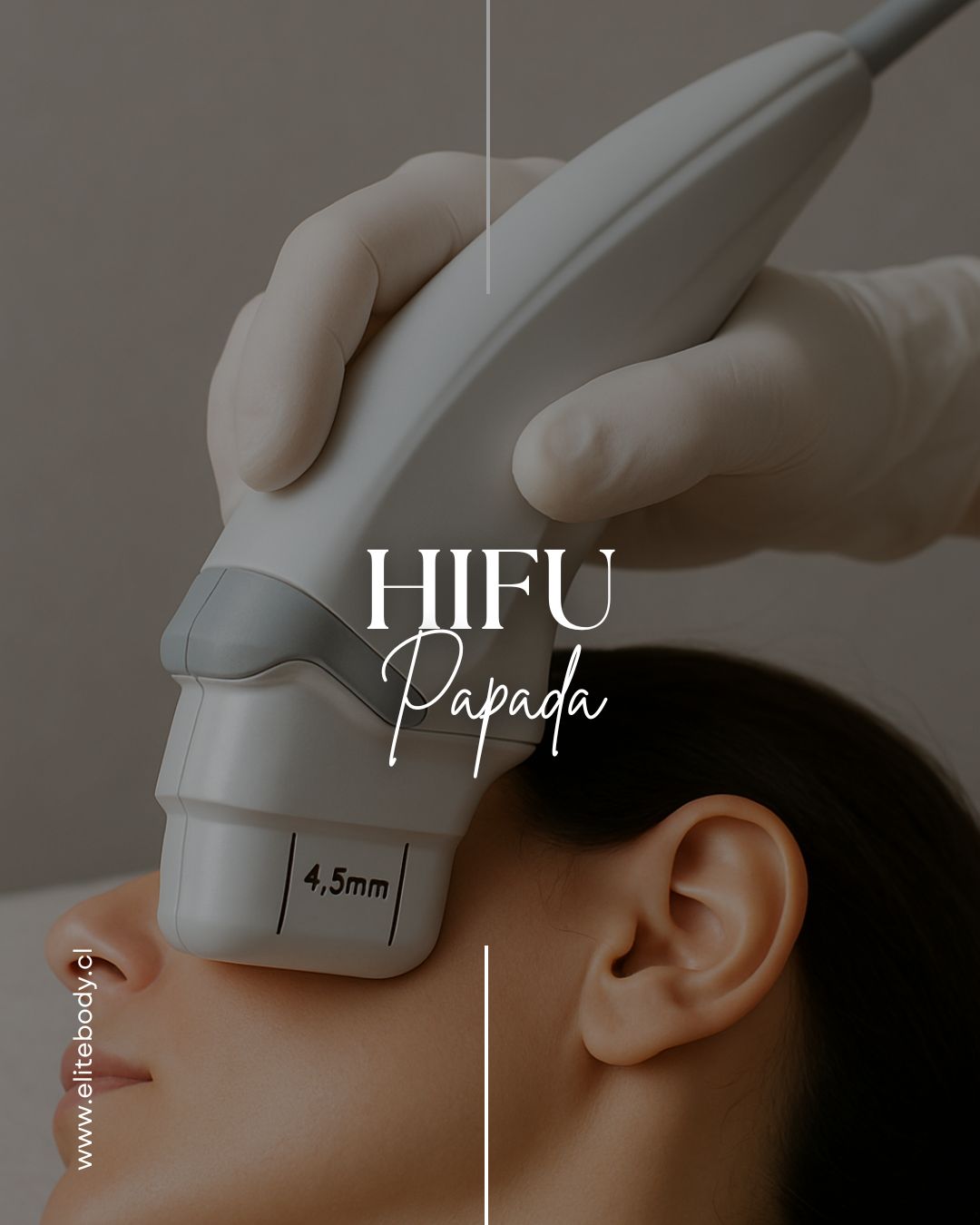 HIFU EN PAPADA