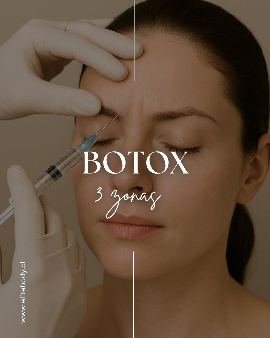 Botox 3 zonas